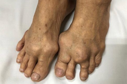 Thống phong - là tên gọi của bệnh gout trong quan niệm của đông y