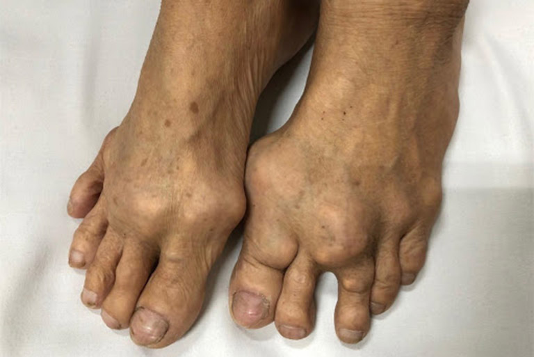 Thống phong - là tên gọi của bệnh gout trong quan niệm của đông y Thống phong - là tên gọi của bệnh gout trong quan niệm của đông y