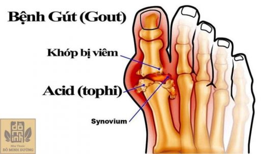 Bệnh gút không còn là bệnh "nhà giàu" mà dần trở nên phổ biến hơn