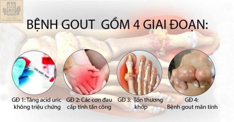 Các giai đoạn phát triển của bệnh gout