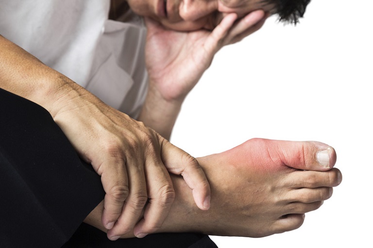 Bệnh gout có những triệu chứng xuất hiện đột ngột