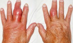 Nếu không được điều trị, bệnh gout có thể gây viêm khớp dẫn đến đau đớn dữ dội