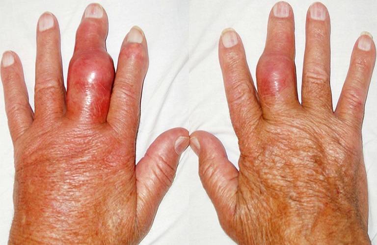 Nếu không được điều trị, bệnh gout có thể gây viêm khớp dẫn đến đau đớn dữ dội