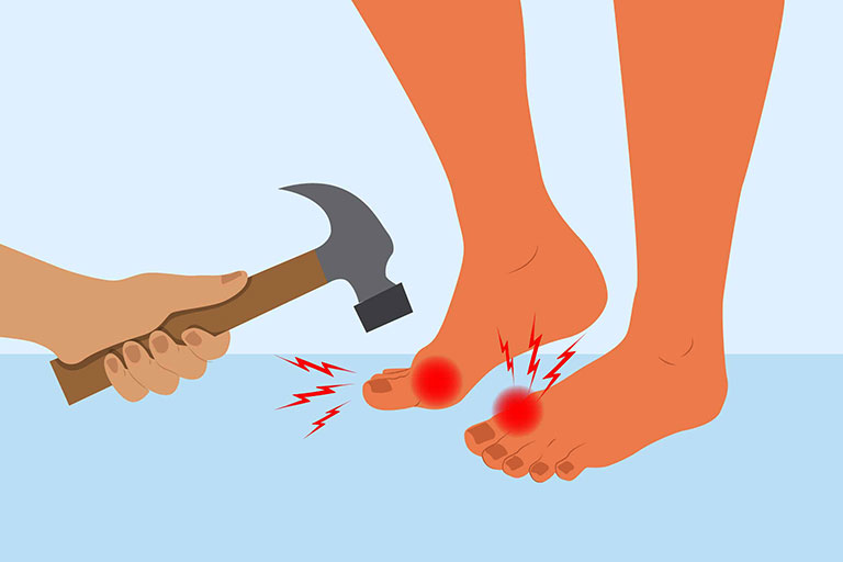 "Đau như búa bổ" vào các khớp, ngón,... là dấu hiệu điển hình của bệnh gout "Đau như búa bổ" vào các khớp, ngón,... là dấu hiệu điển hình của bệnh gout
