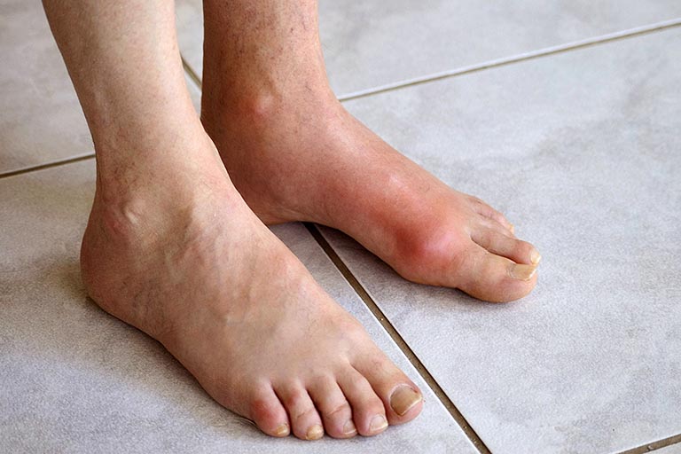 Dấu hiệu bệnh gout