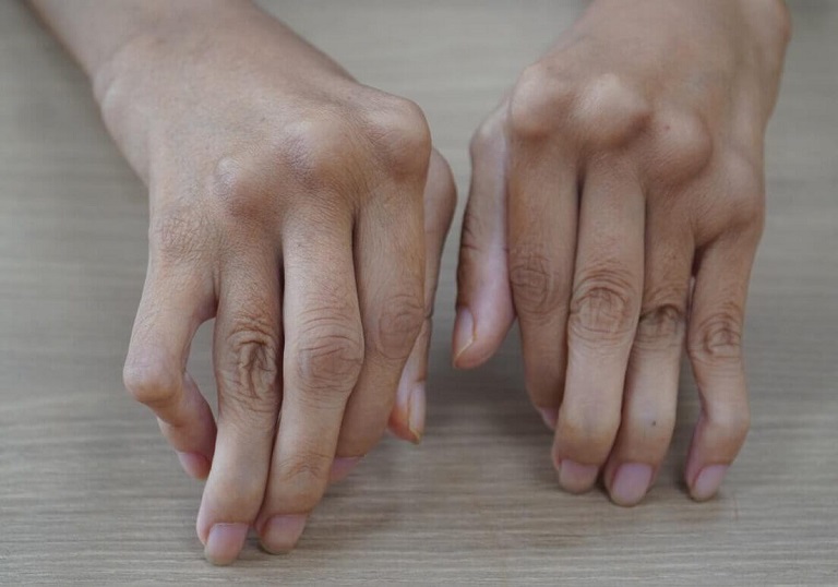 Viêm đa khớp là một trong những dấu hiệu của bệnh gout mãn tính Viêm đa khớp là một trong những dấu hiệu của bệnh gout mãn tính