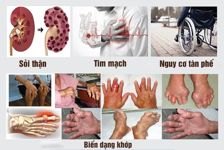 Biến chứng gout